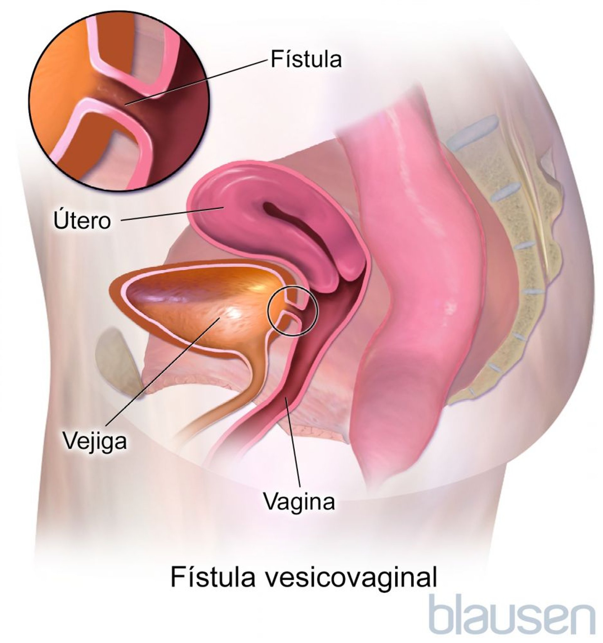 Fístula vesicovaginal