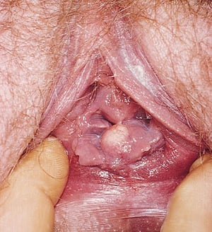 Vaginal Inclusion Cyst