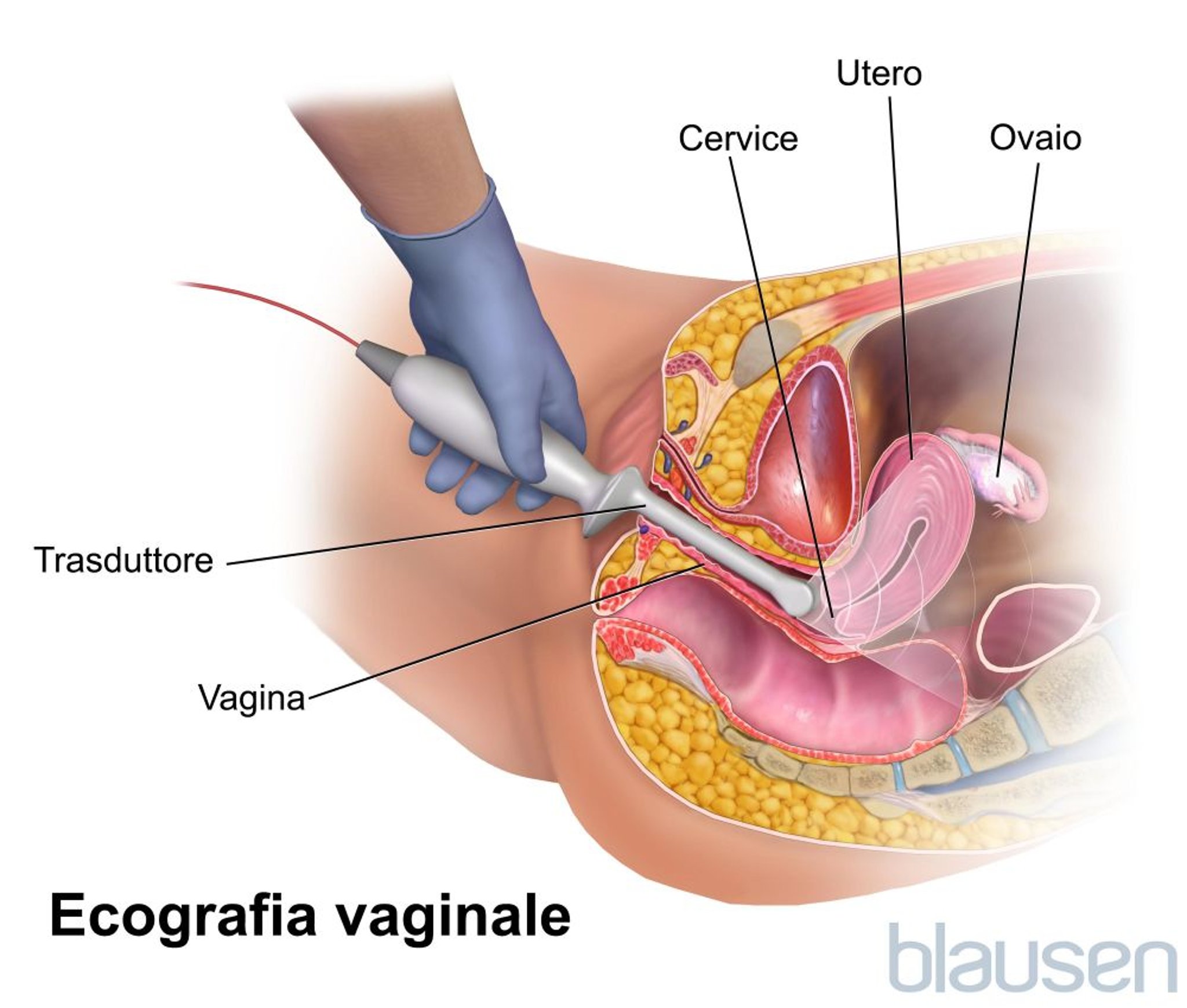 Ecografia transvaginale