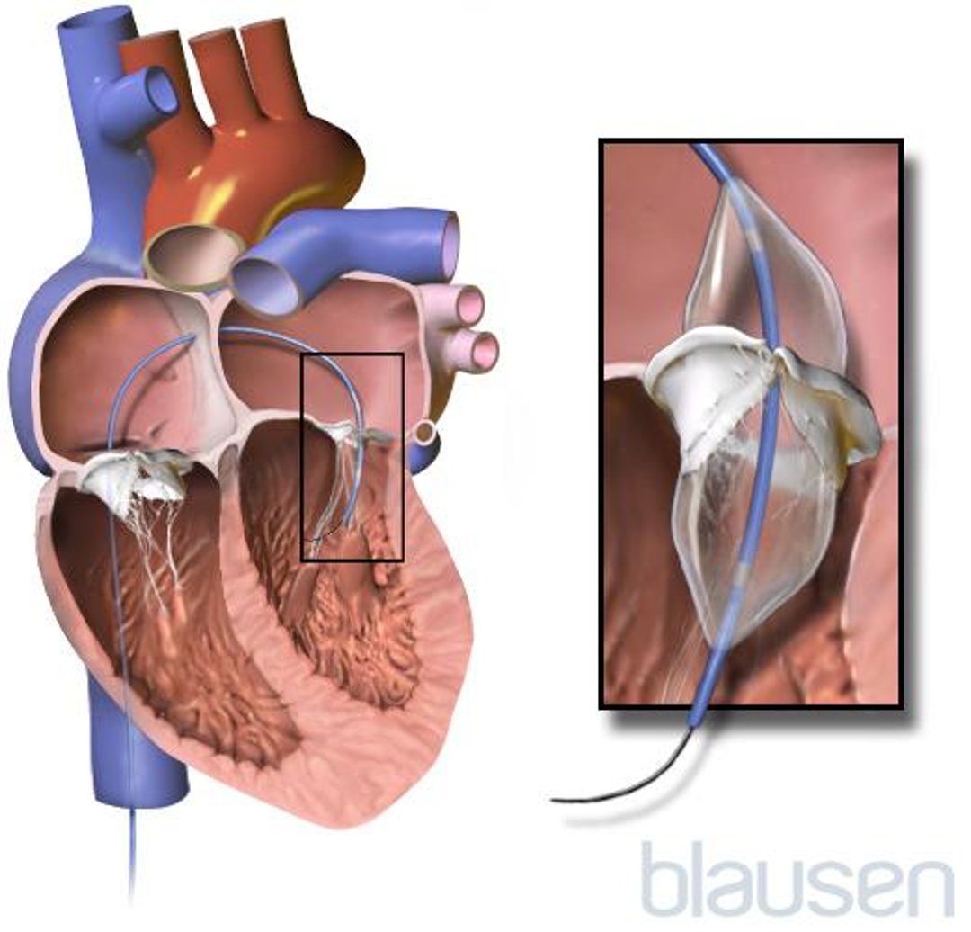 Valvuloplasty for Mitral Stenosis