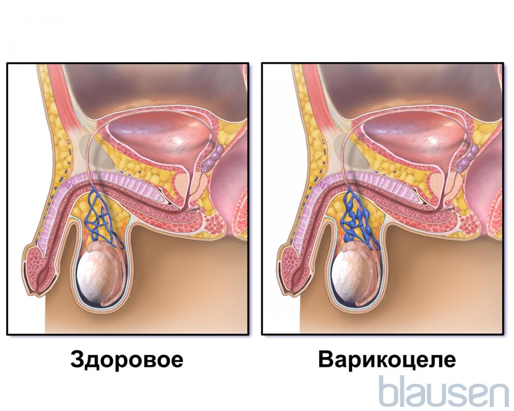 Варикоцеле