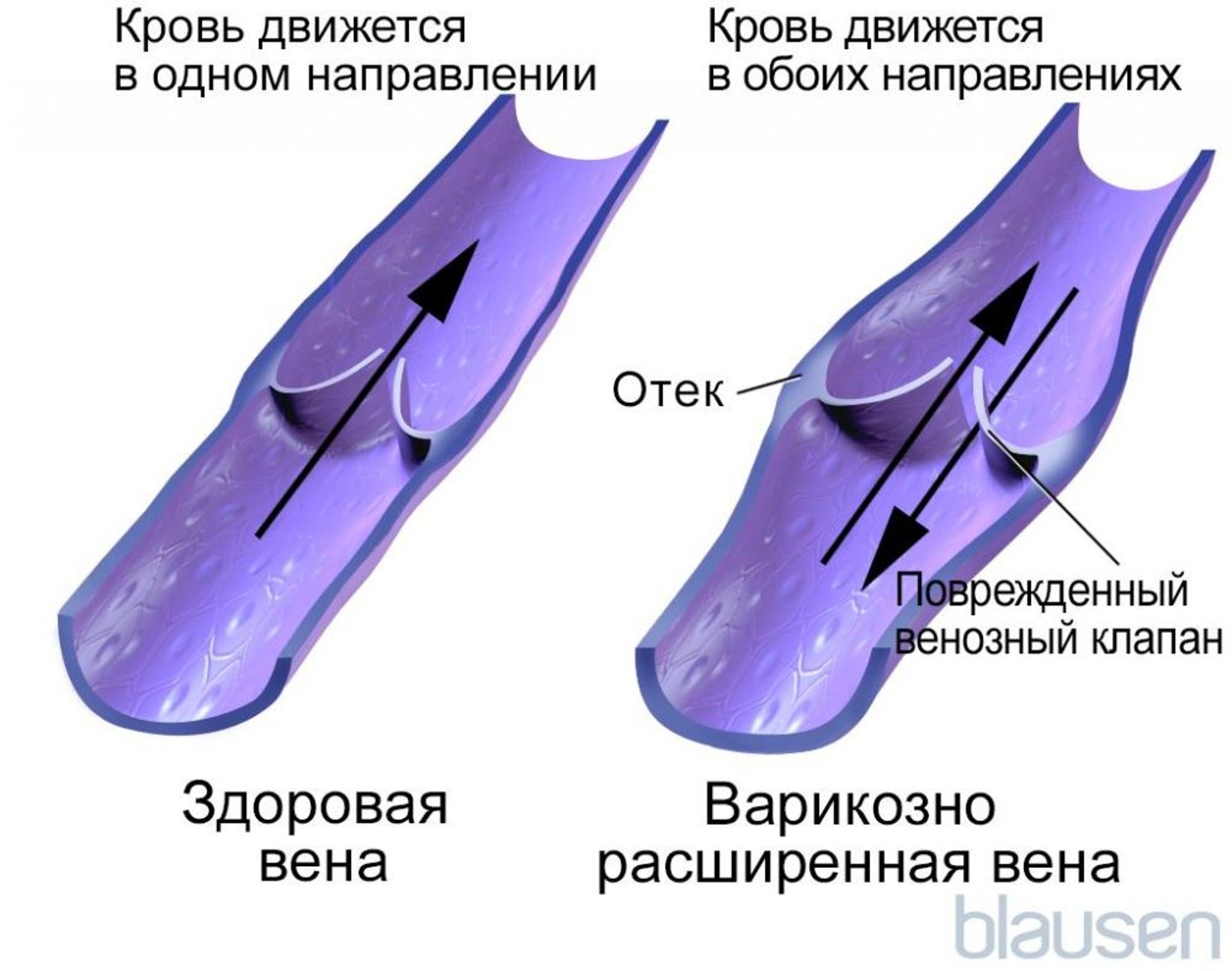 Кровоток в варикозно измененных венах