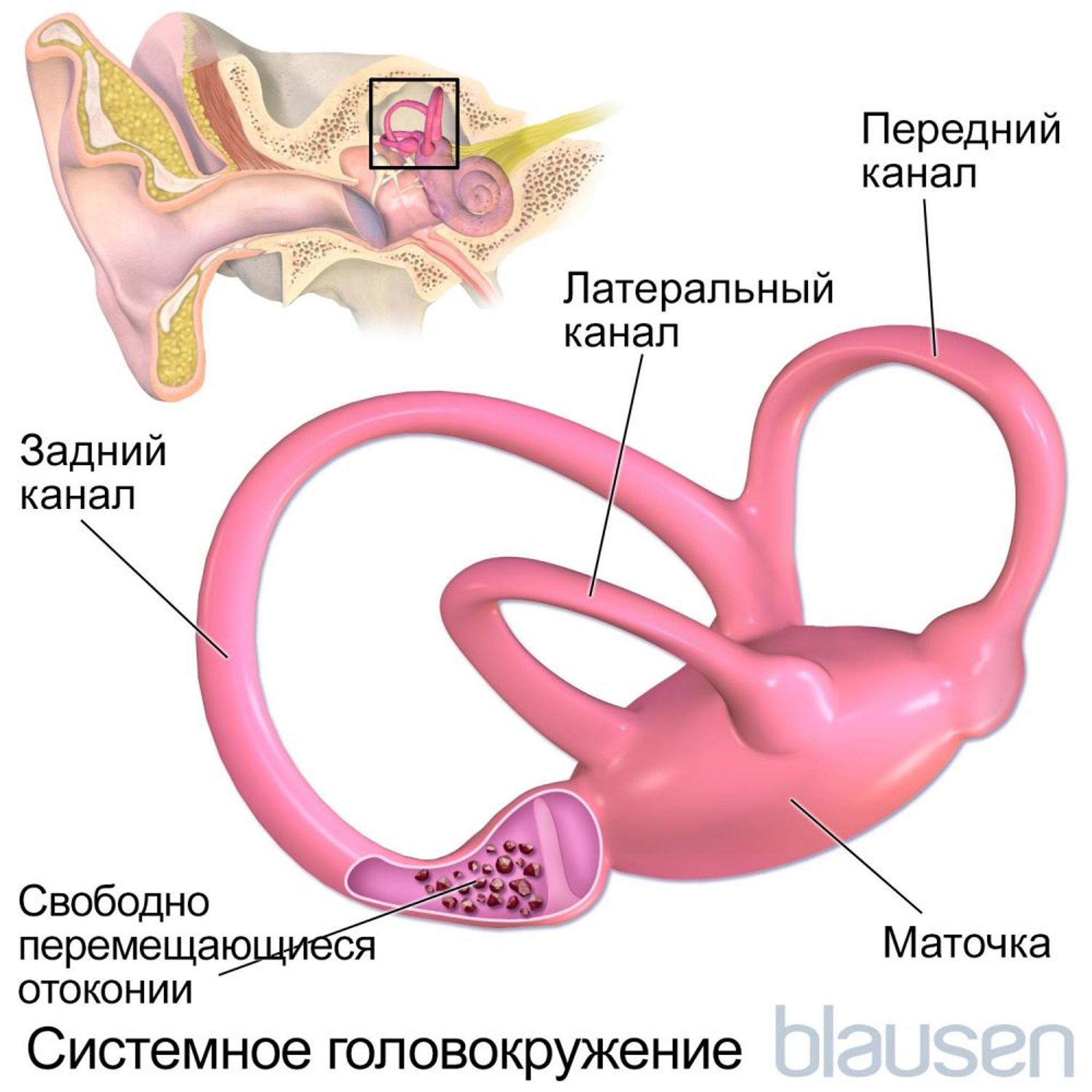 системное головокружение;