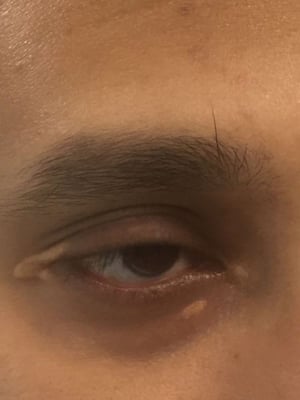 眼睑黄斑瘤