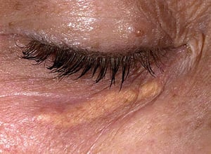 Xanthelasma