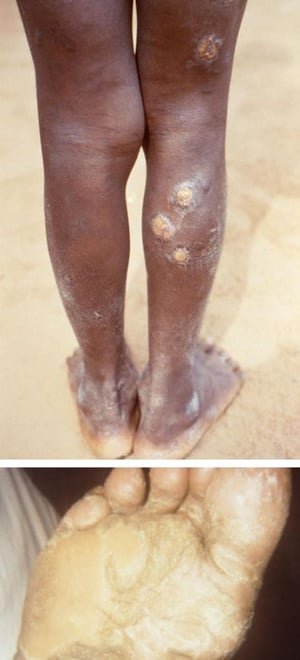 イチゴ腫：軟らかいこぶ状の結節