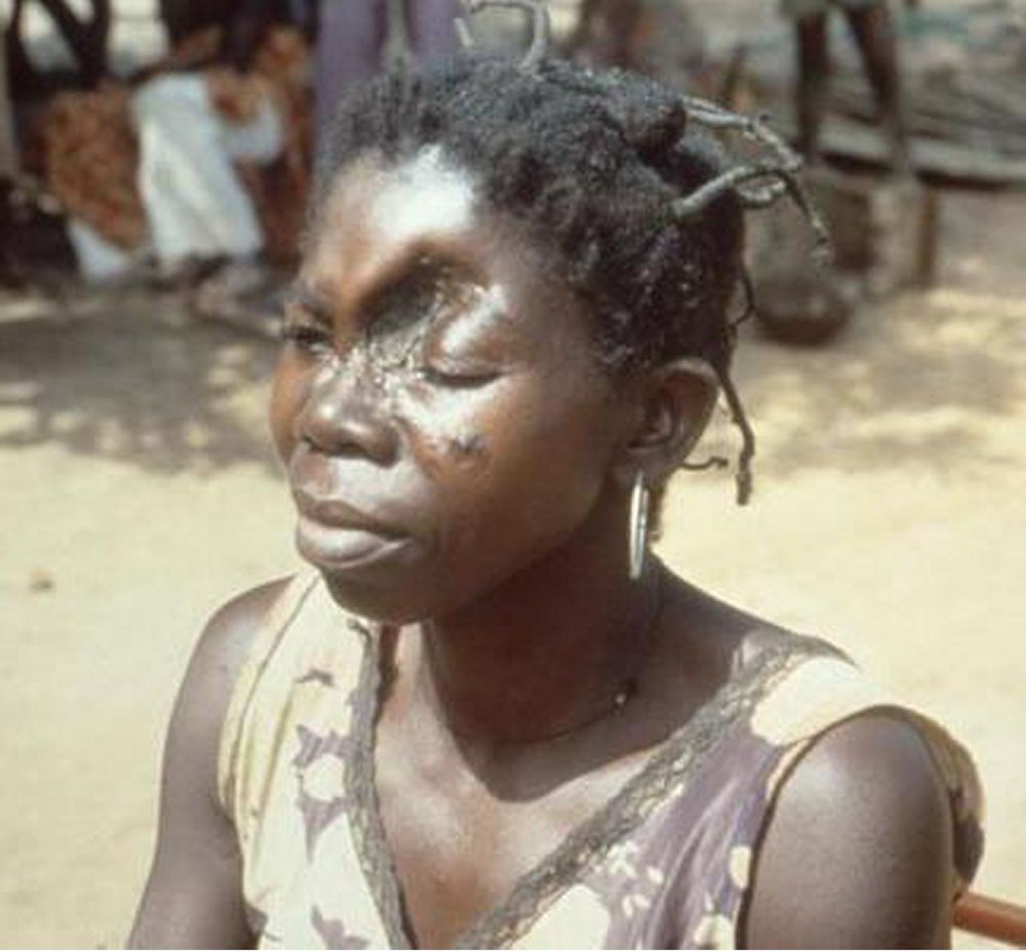 Bouba: Crescimentos desfigurantes