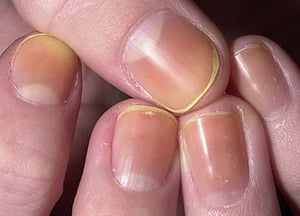 Alteración de la coloración de las uñas debida al esmalte de uñas