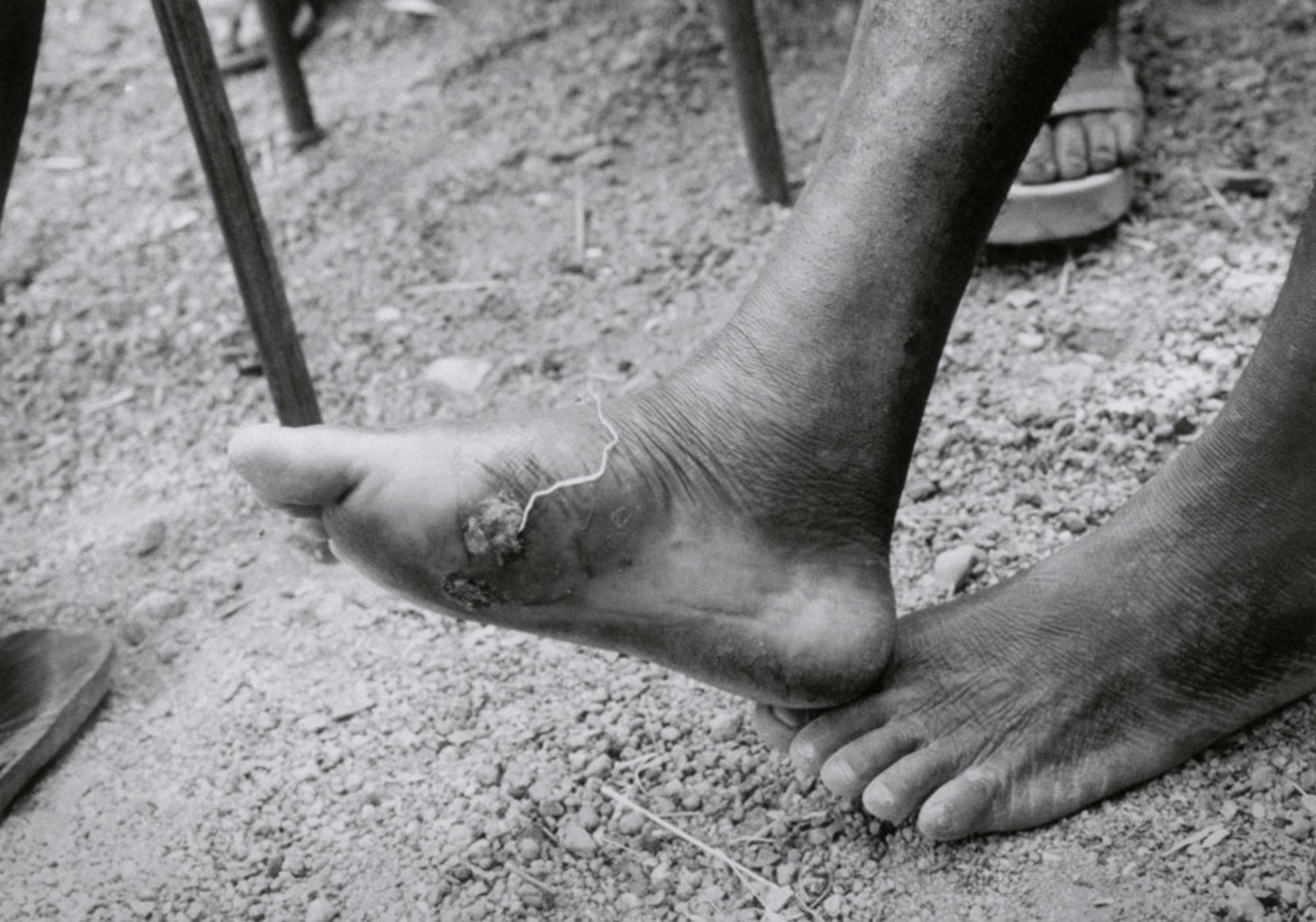 Emerging Guinea Worm