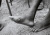Emerging Guinea Worm
