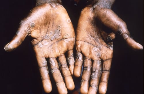 Mpox (Monkeypox)