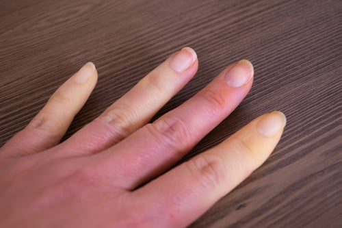 Raynaud Syndrome