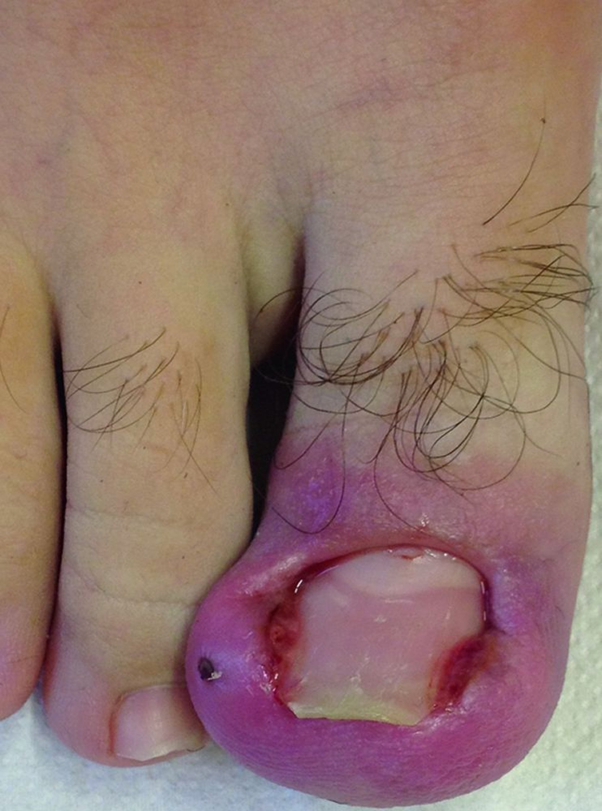 Ingrown Toenail with Extensive Inflammation