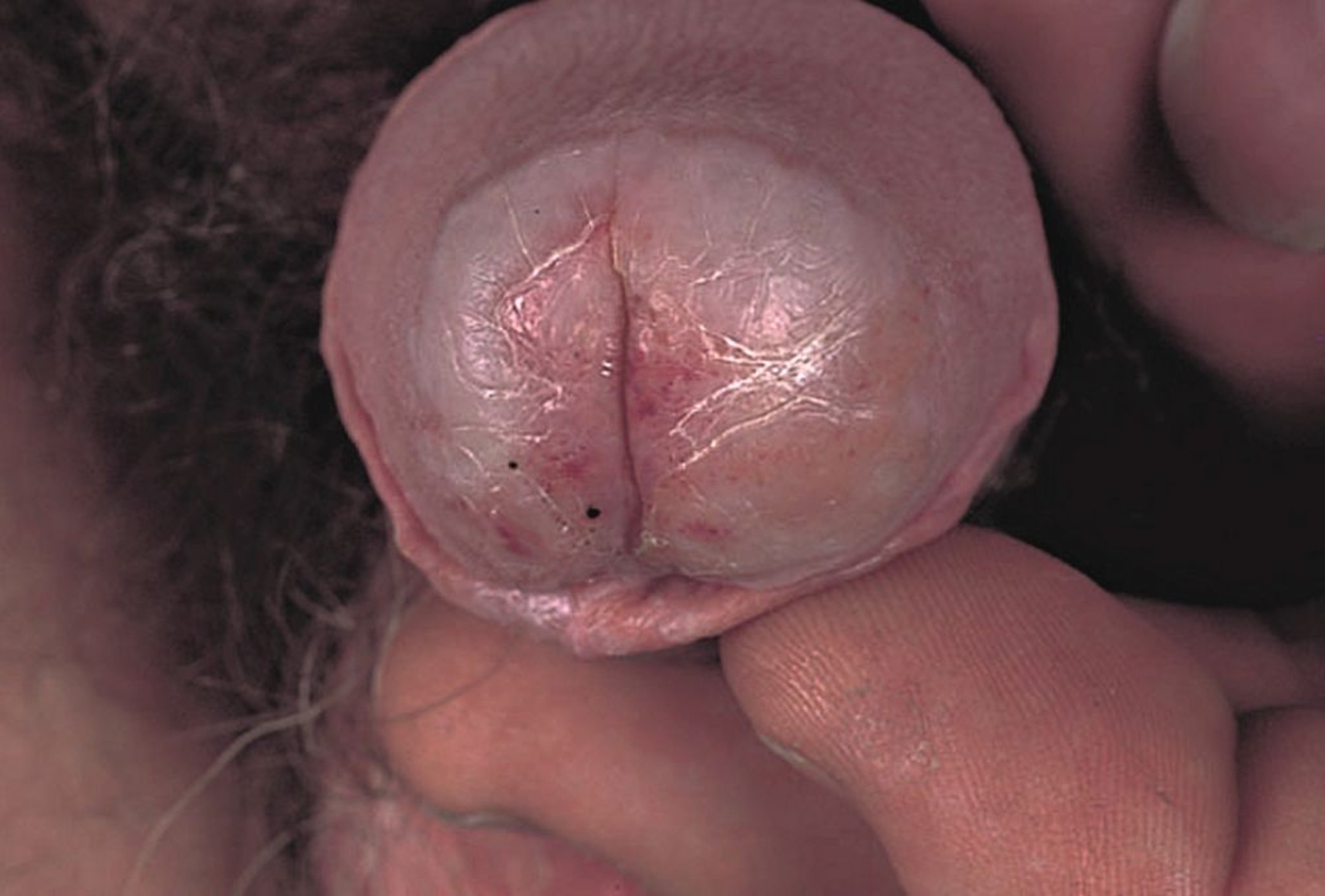 閉塞性乾燥性亀頭炎