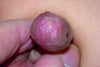 Balanitis Xerotica Obliterans With Meatal Occlusion
