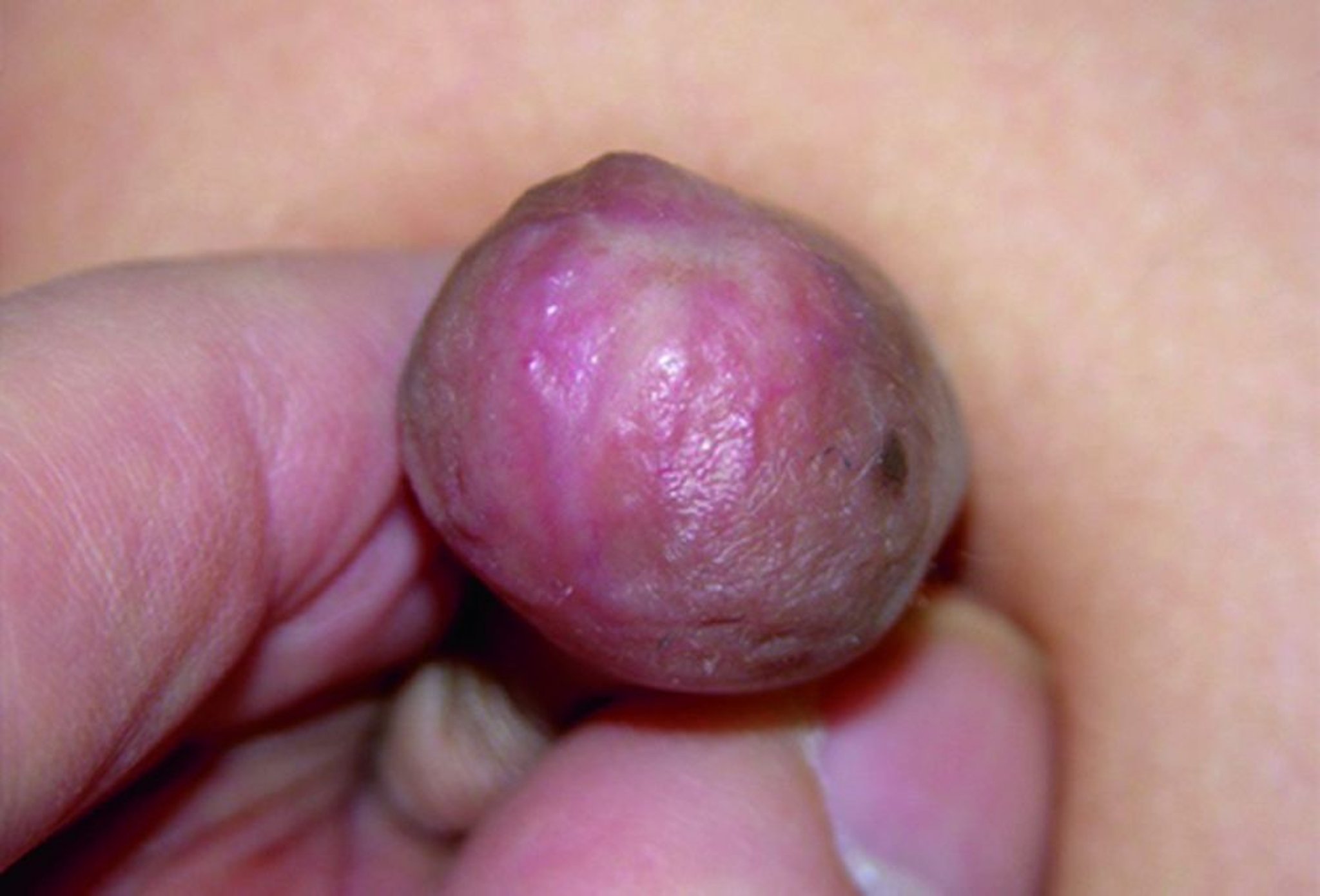 Balanitis xerótica obliterante con oclusión del meato