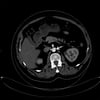 Atherosclerotic Plaque in Descending Aorta