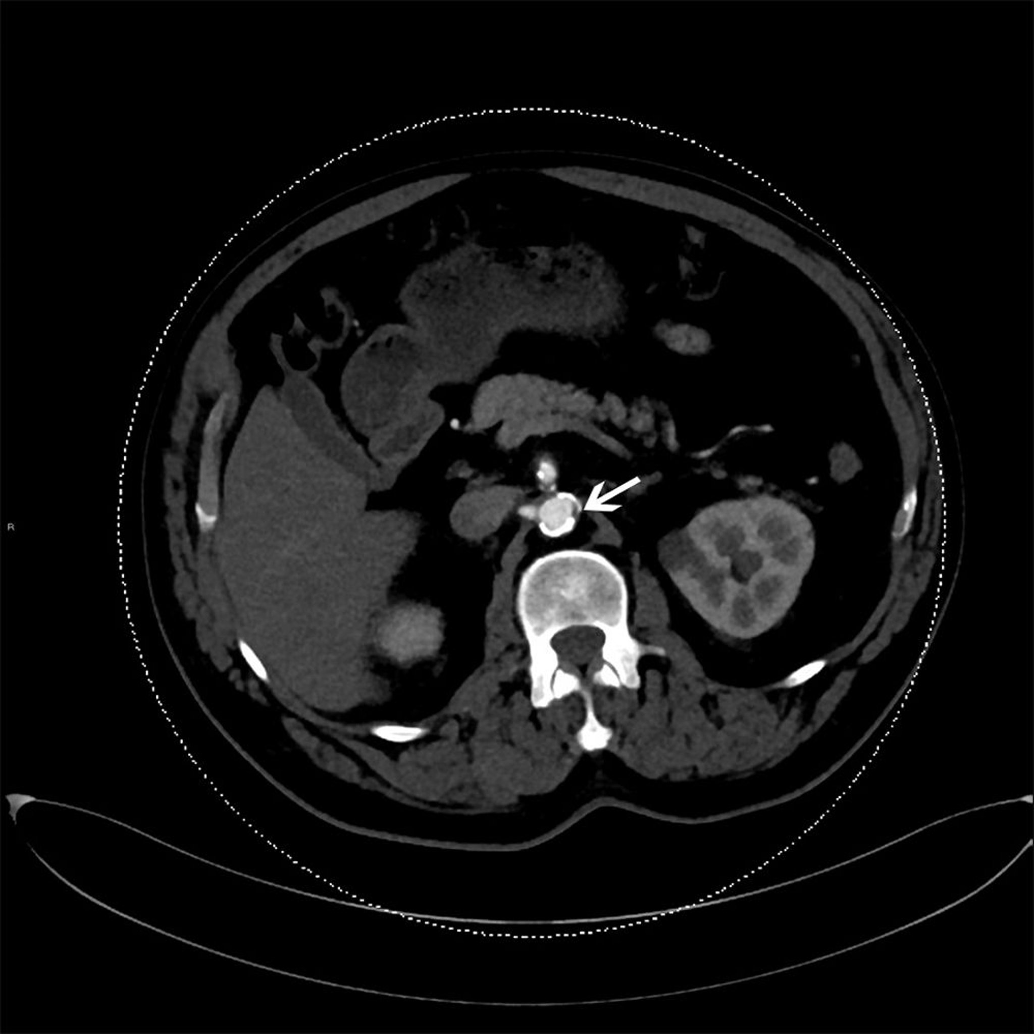 Atherosklerotische Plaque in der absteigenden Aorta