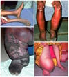Lymphatic Filariasis (Range of Severity of Lymphedema)