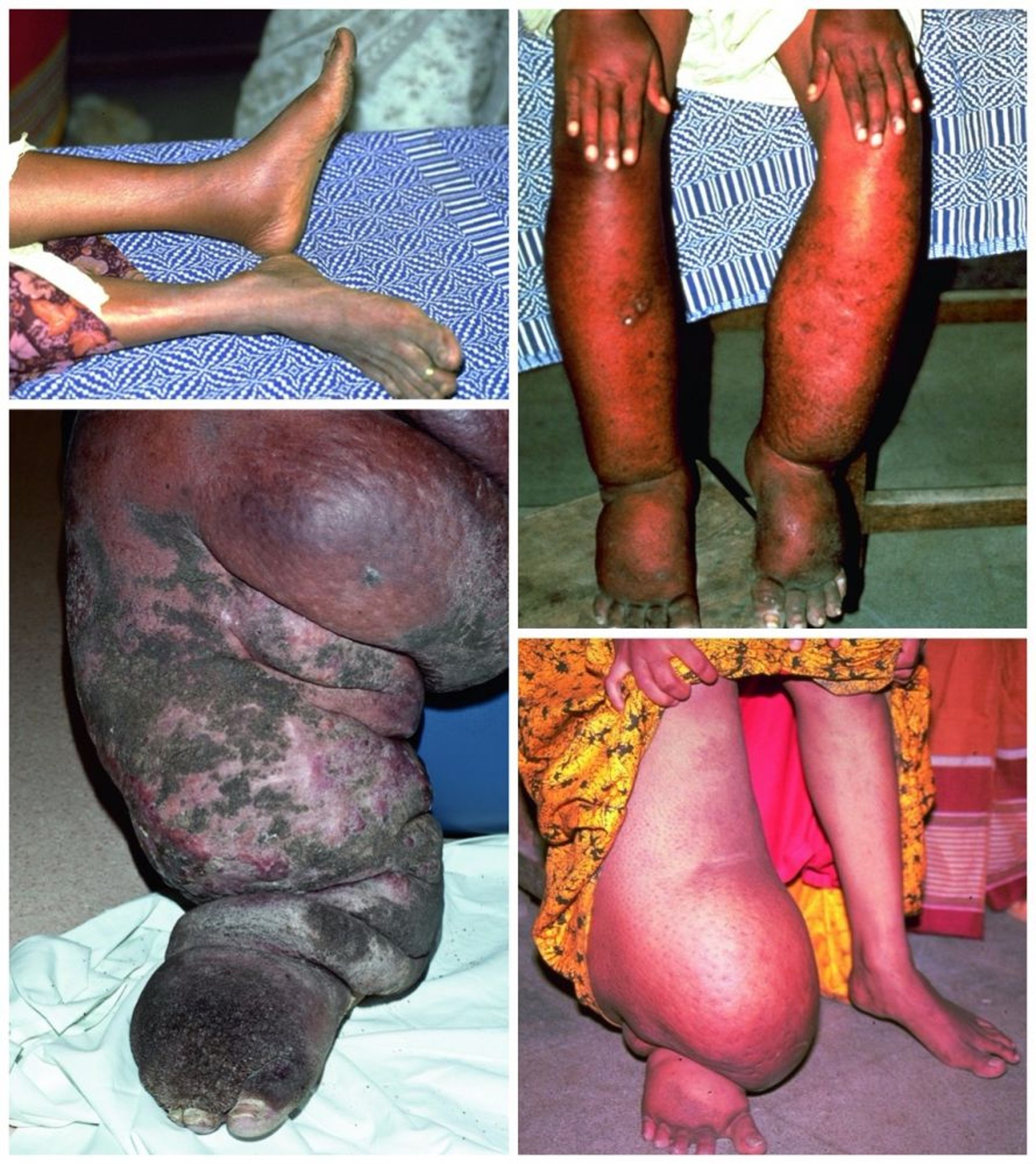 Lymphatische Filariose (Schweregrad des Lymphödems)