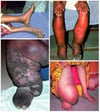 Filariasis linfática (rango de gravedad del linfedema)