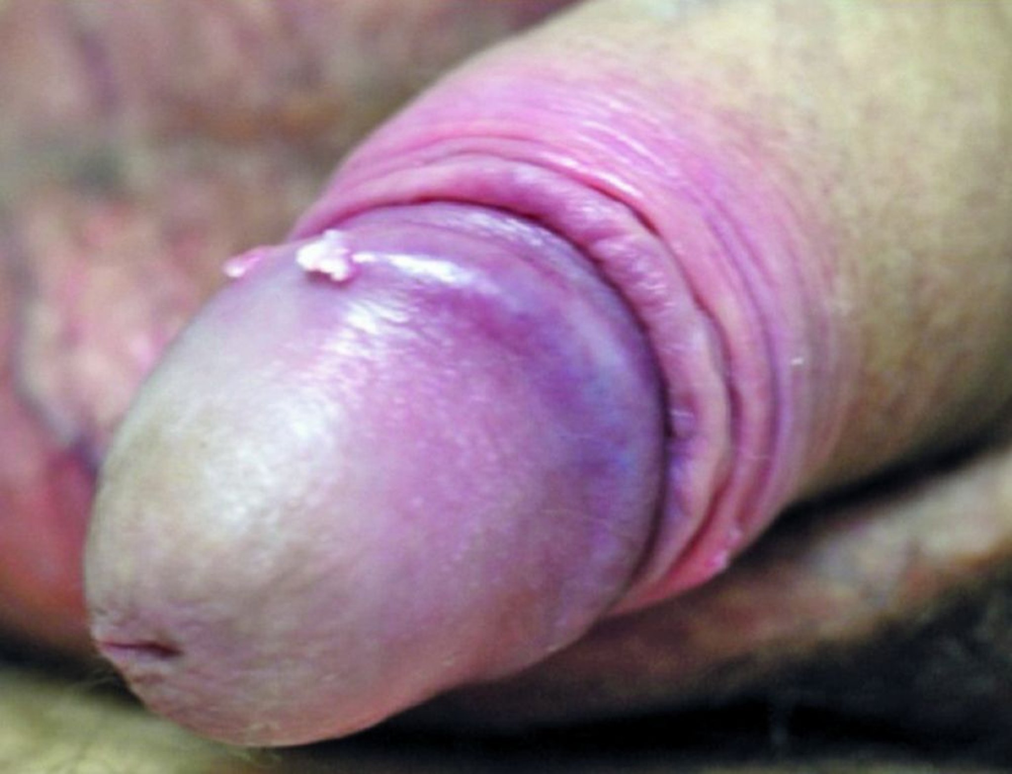 Verrues génitales (gland)