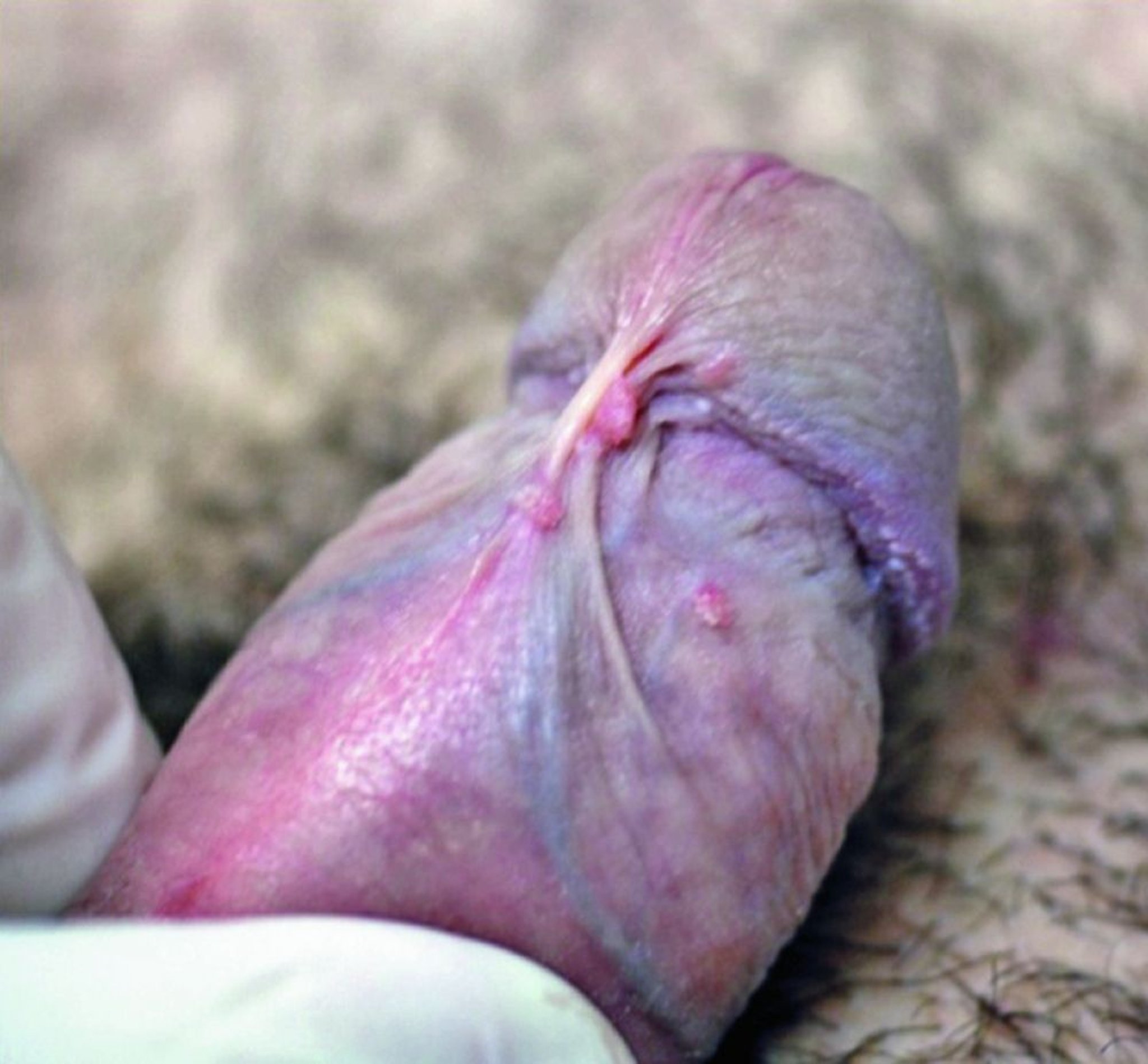 Verrugas genitales (cuerpo del pene)