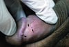 Genital Warts (Coronal Sulcus)