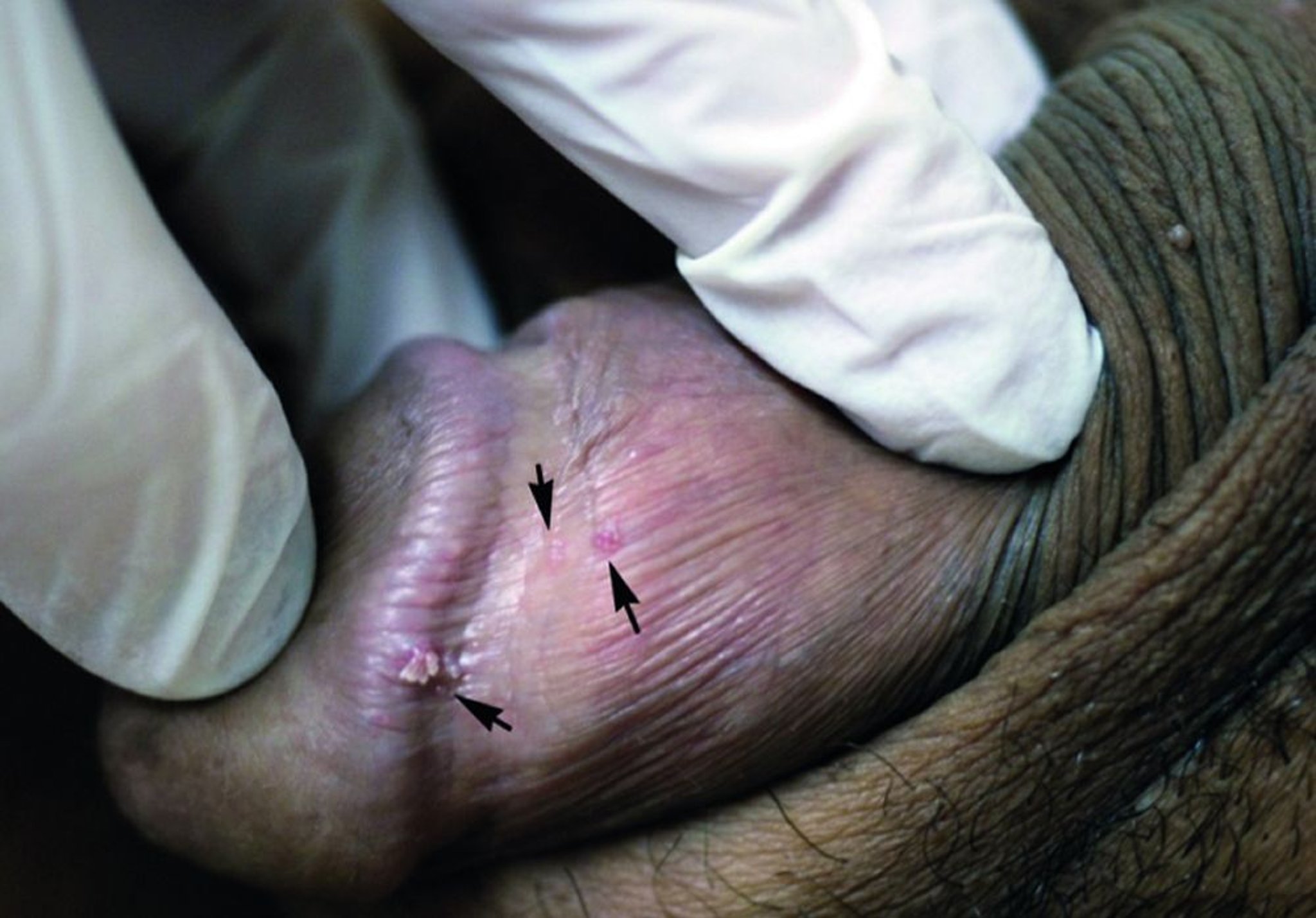 Verrues génitales (sulcus coronal)