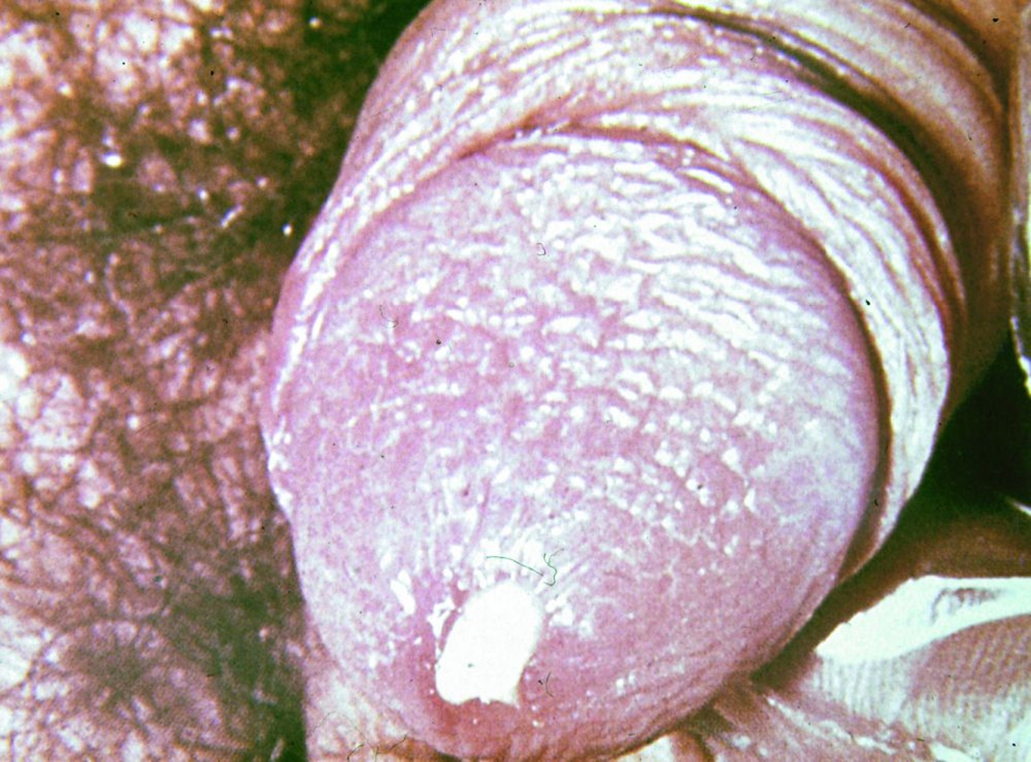 Gonorrhée (urétrite)