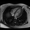 Cardiomyopathie hypertrophique (variante apicale)