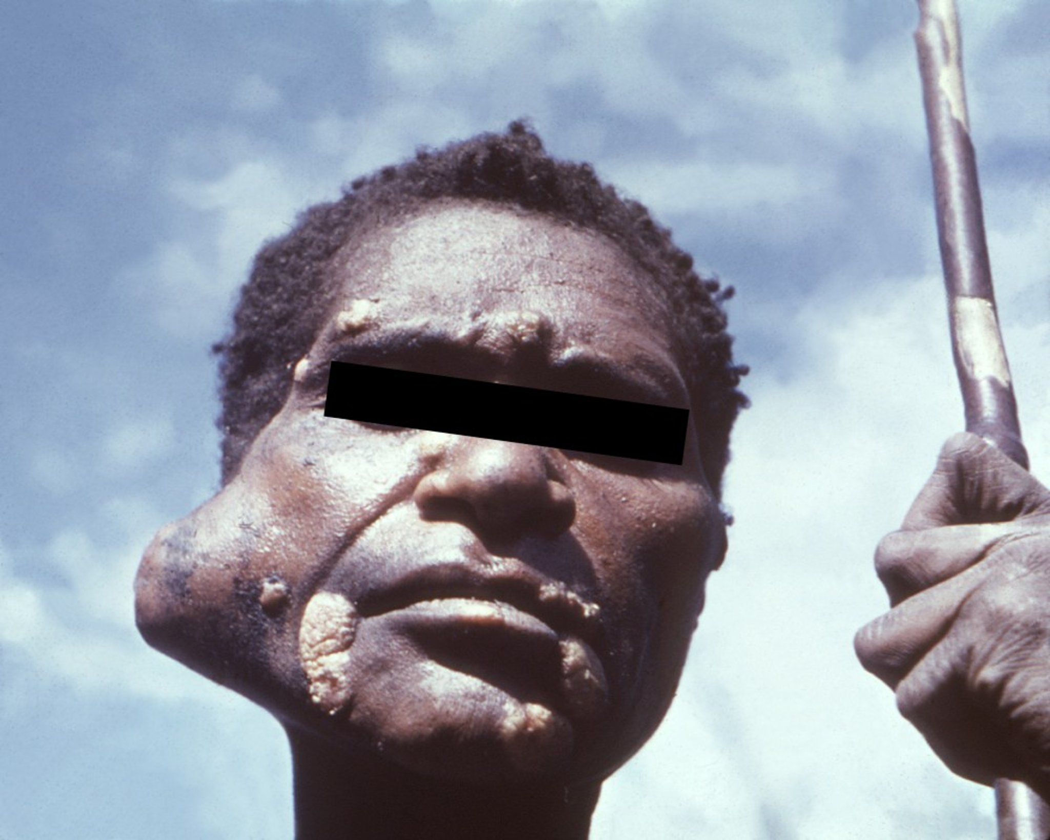 Parotid Salivary Gland Tumor