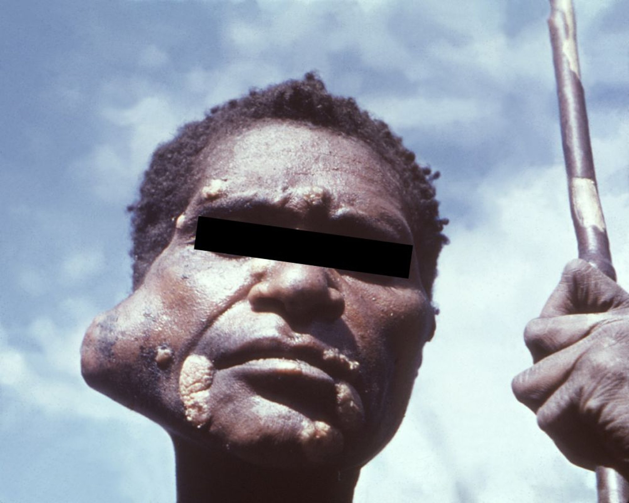 Опухоль околоушной слюнной железы