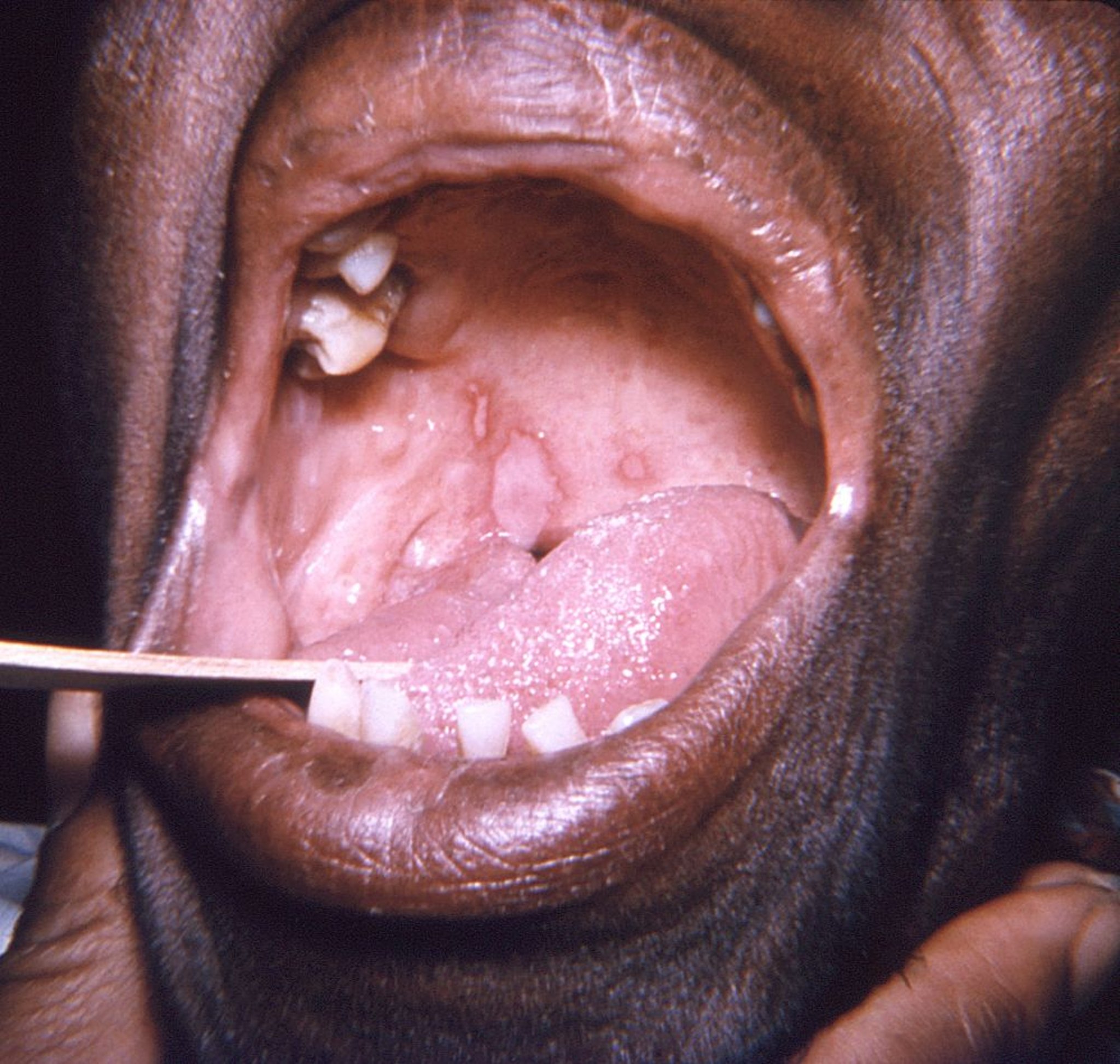 Herpes labial (palato mole e língua)