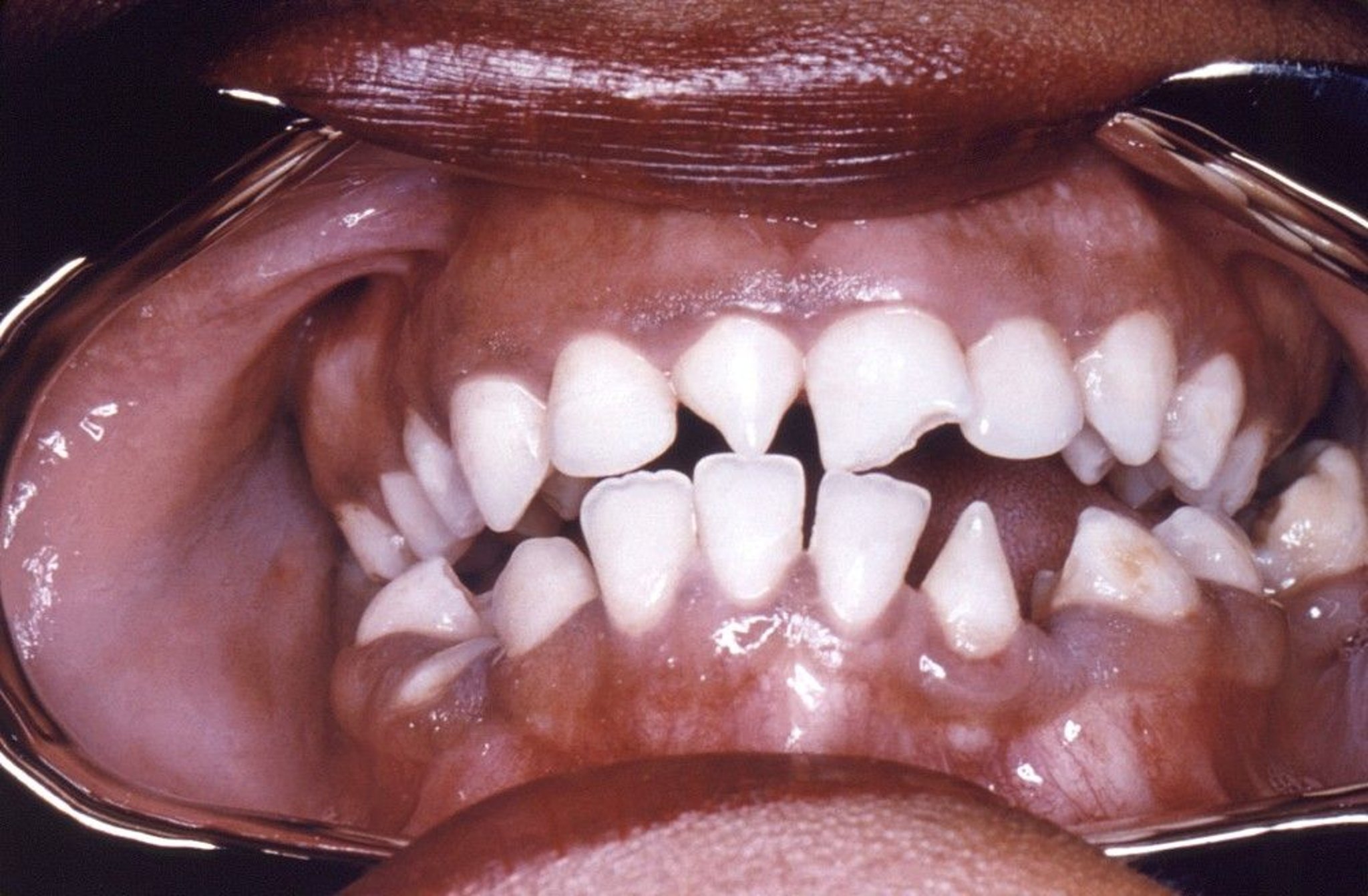 Hutchinson Incisors