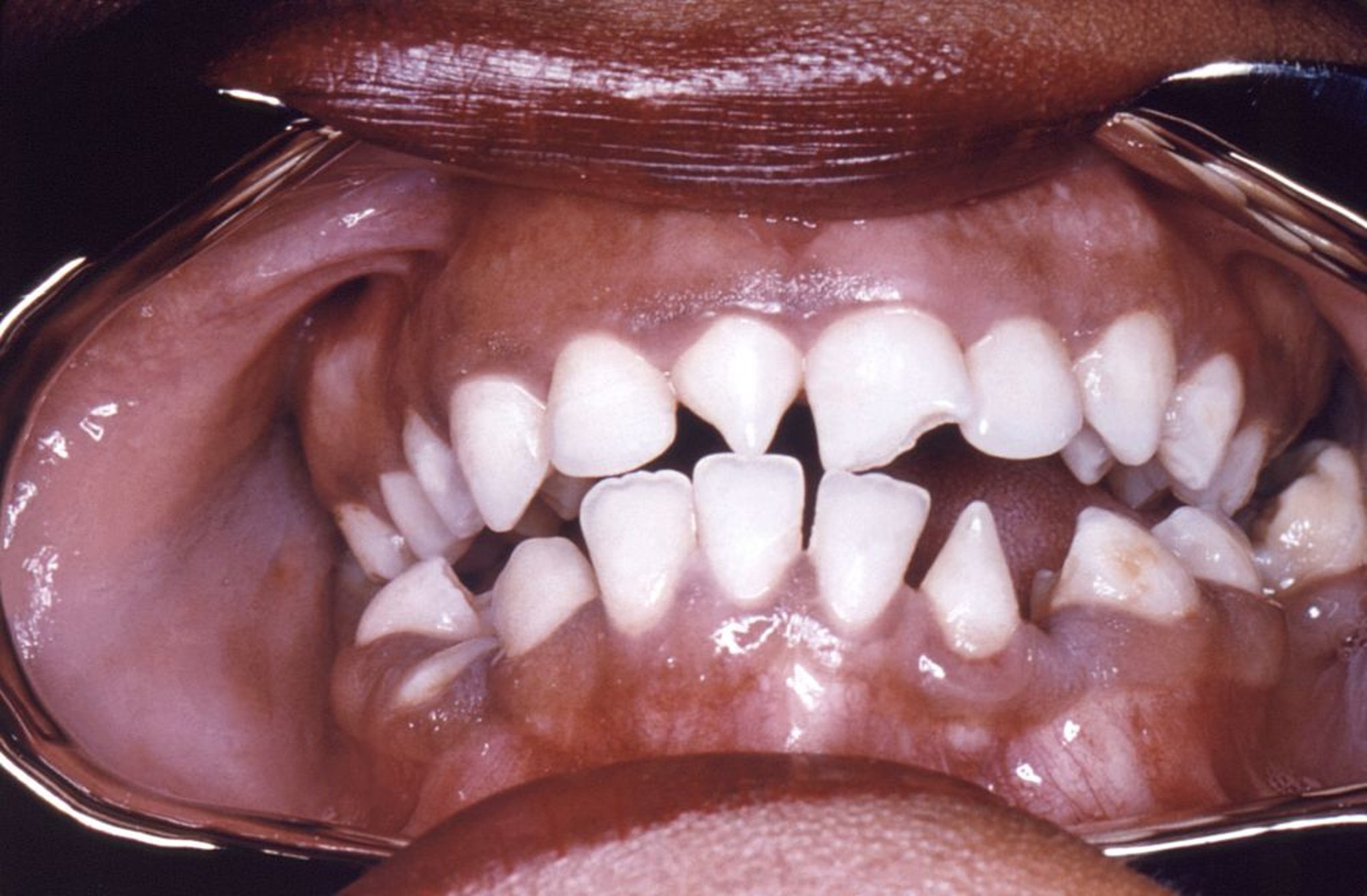 Hutchinson Incisors