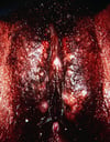 Genital Herpes