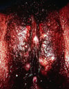 Herpes Genitalis
