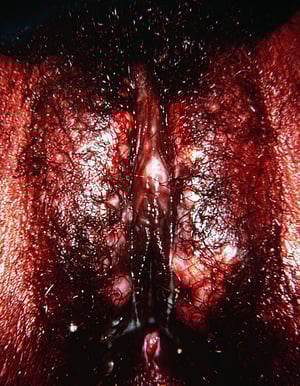 Herpes genitale