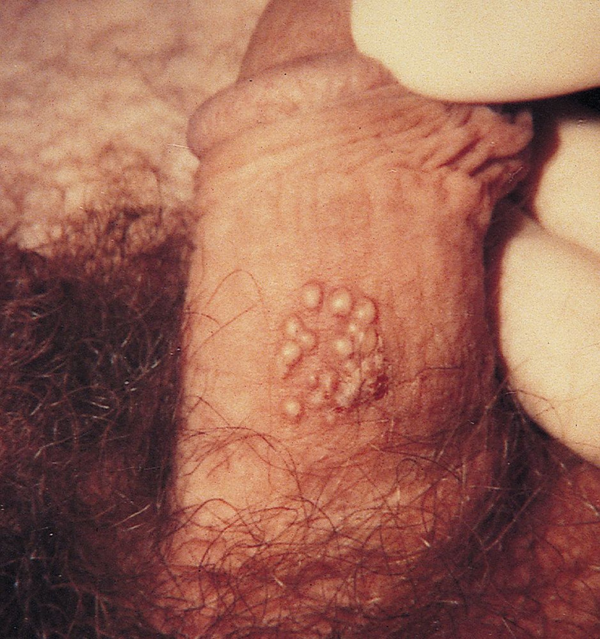 Herpes genital (varón)