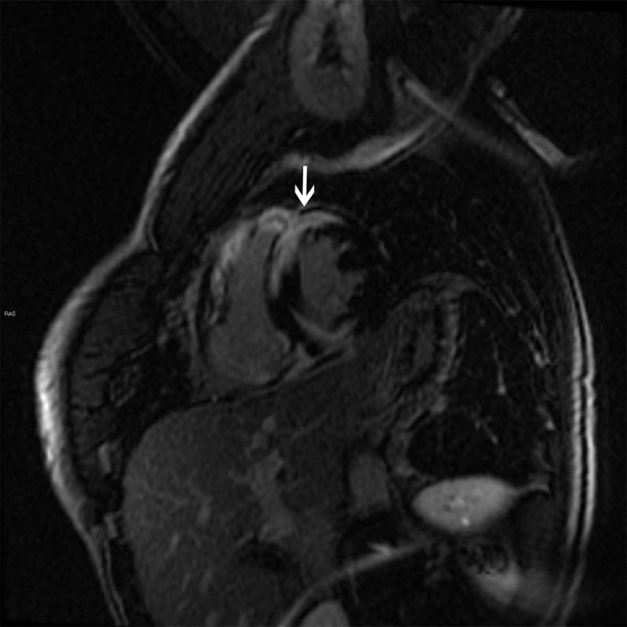 Hallazgos en la resonancia magnética de la sarcoidosis cardíaca