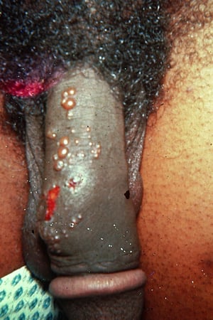 Herpes genitale (pene)