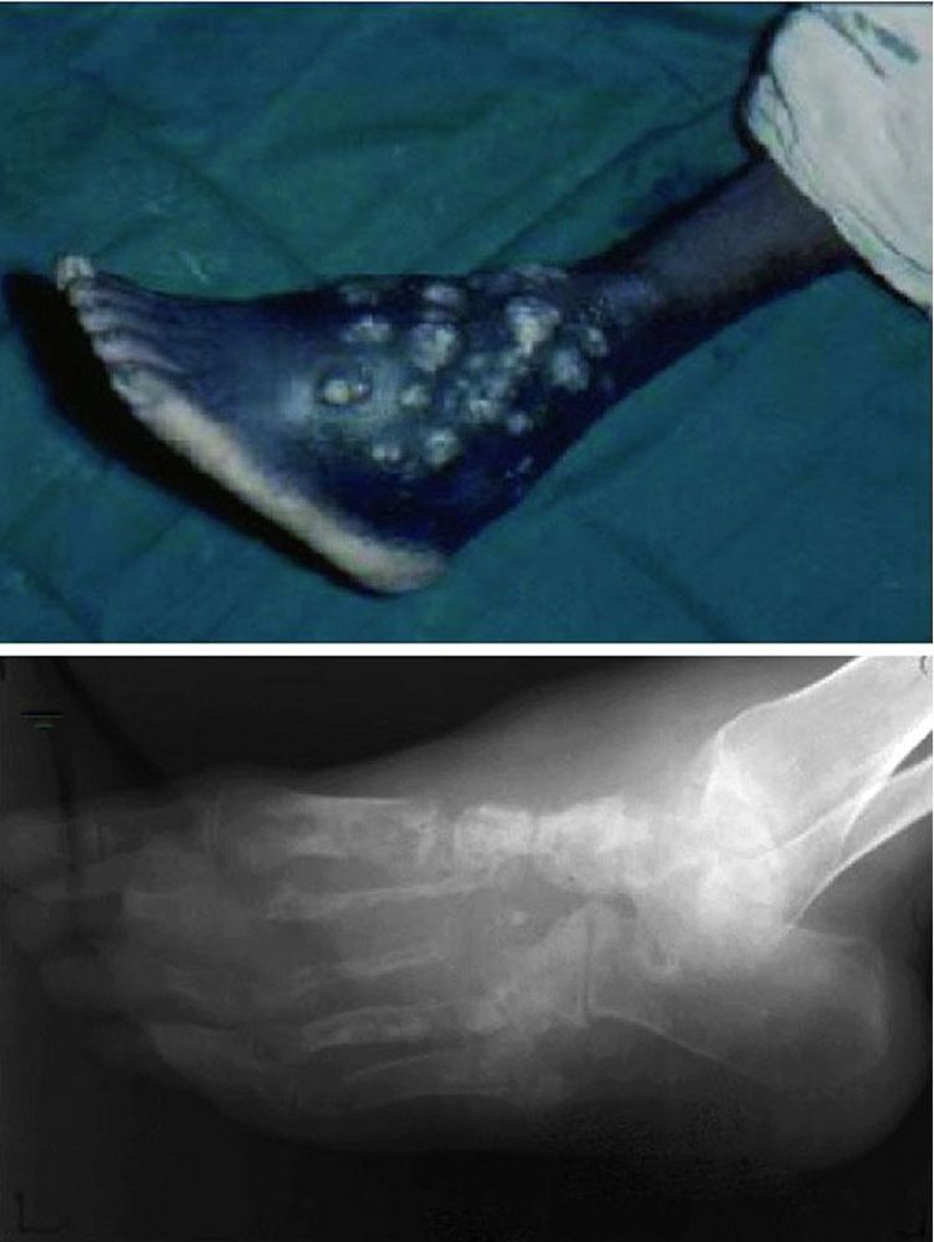 Mycetoma (Madura Foot)