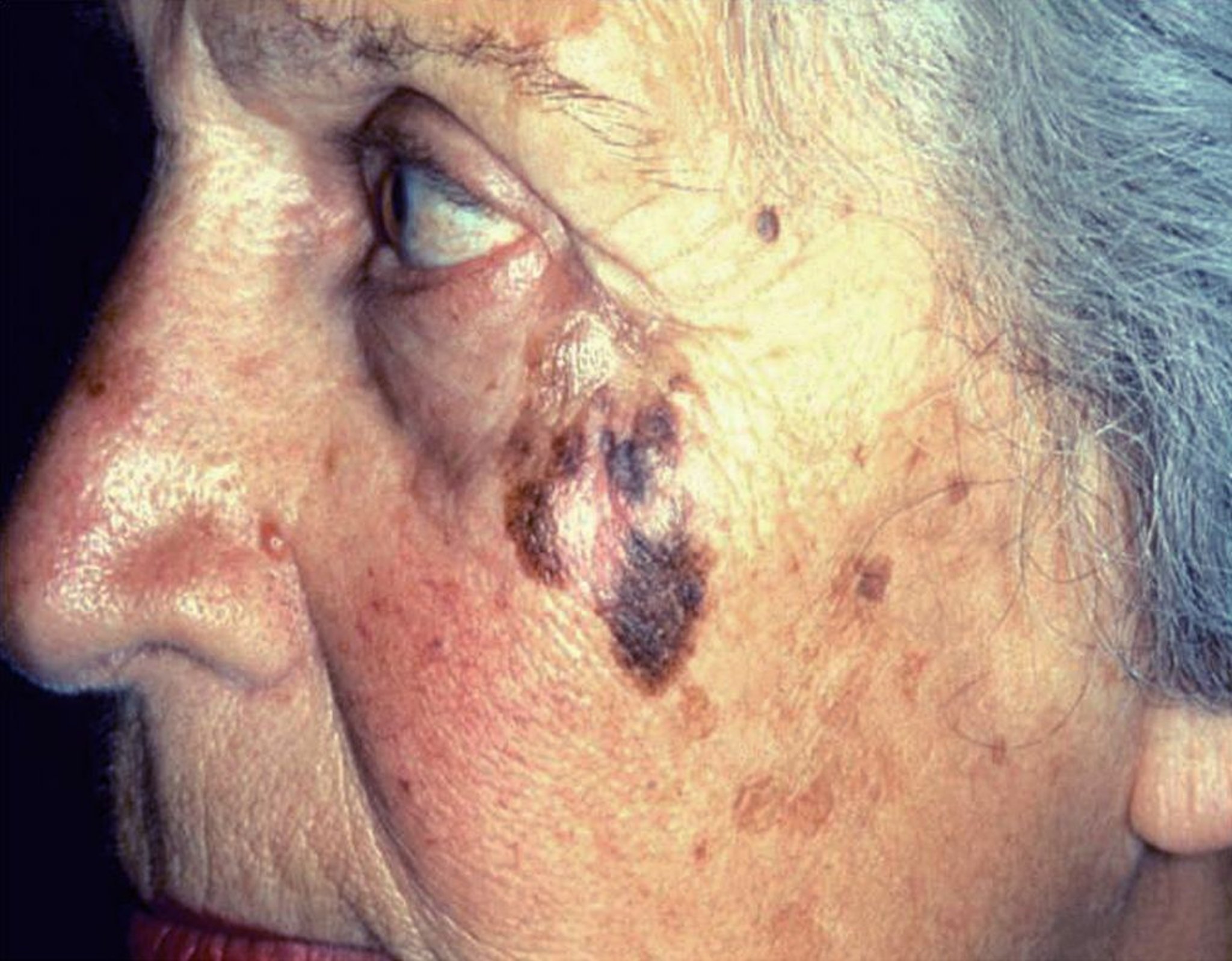 Lentigo maligno-melanoma (Face)