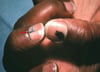 Acral-Lentiginous Melanoma