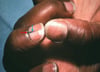 Melanoma lentiginoso acral (signo de Hutchinson)