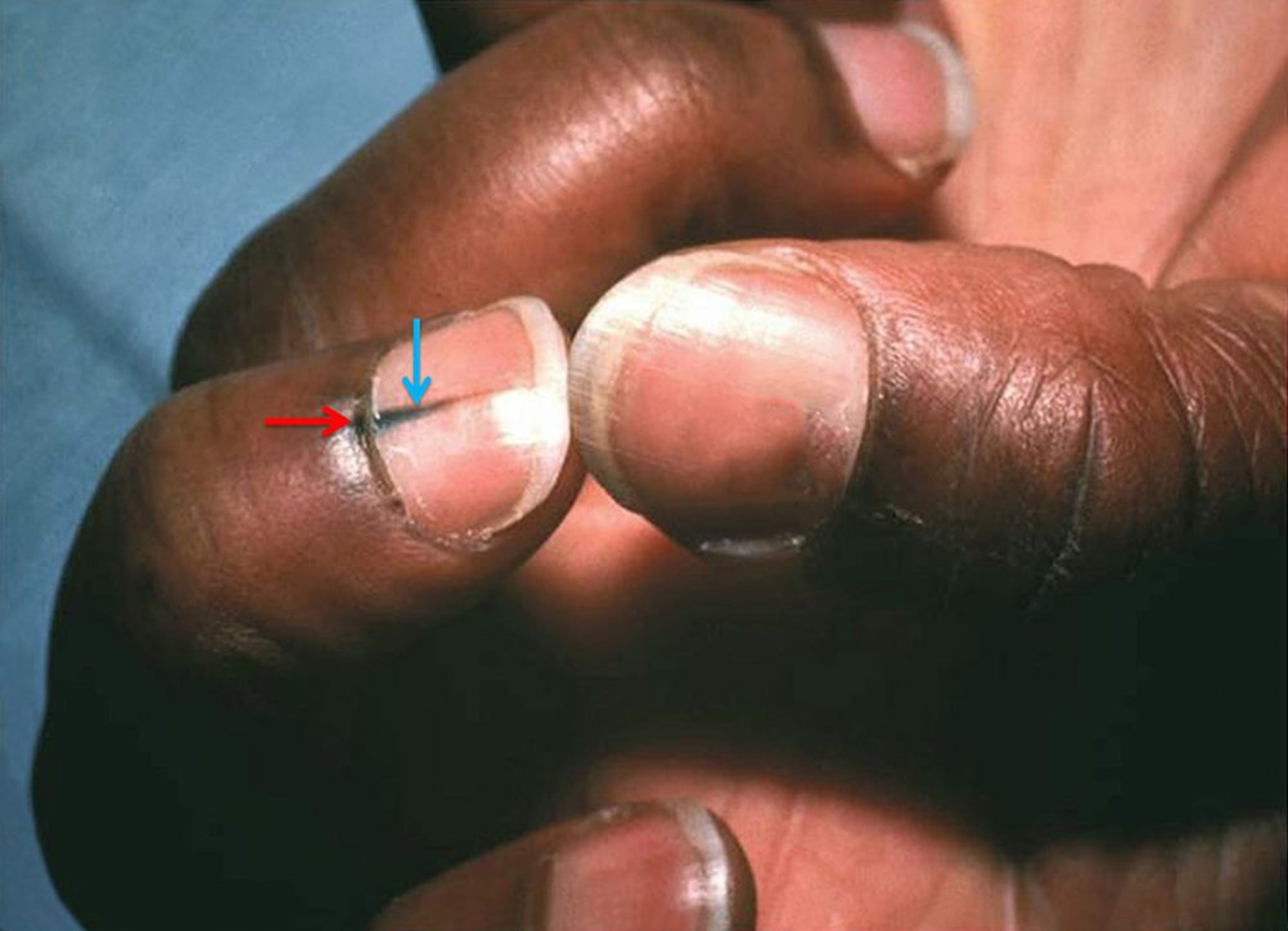 Melanoma lentiginoso acral (signo de Hutchinson)