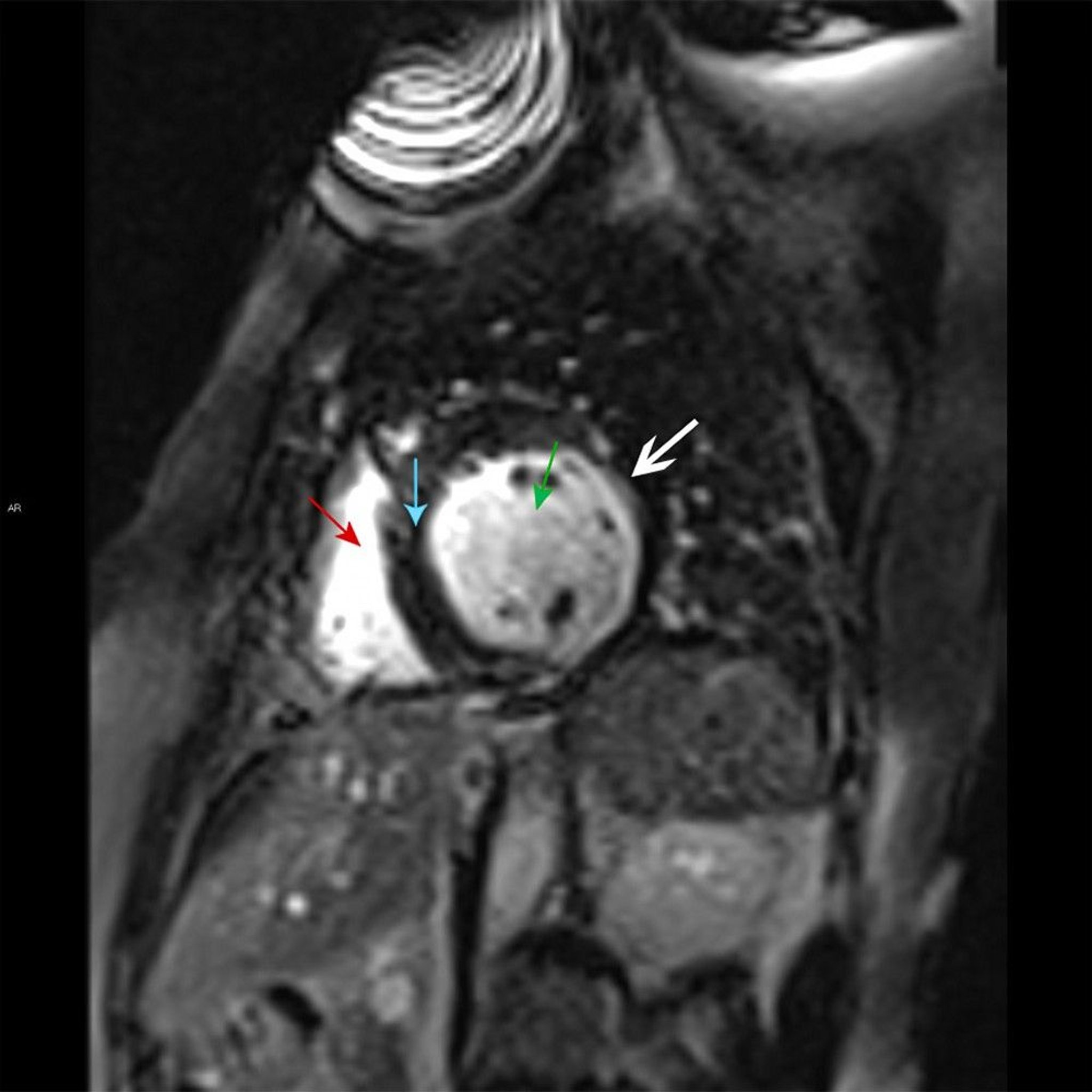 MRI Findings of Myocardial Infarct