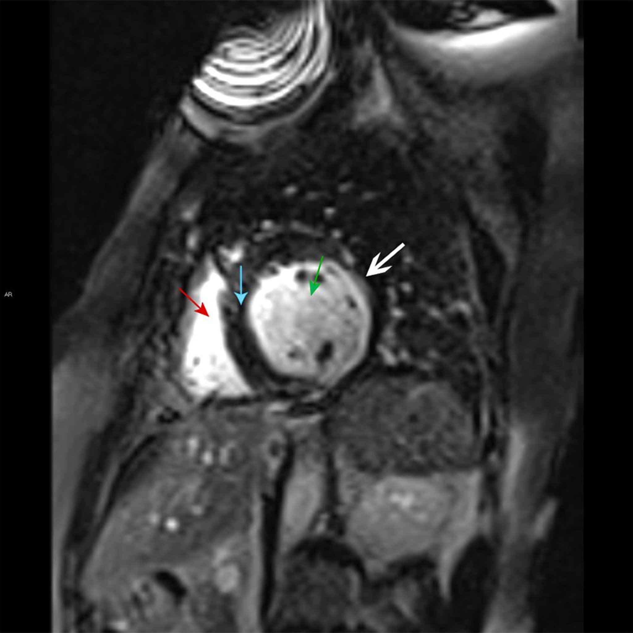 Hallazgos en la resonancia magnética del infarto de miocardio