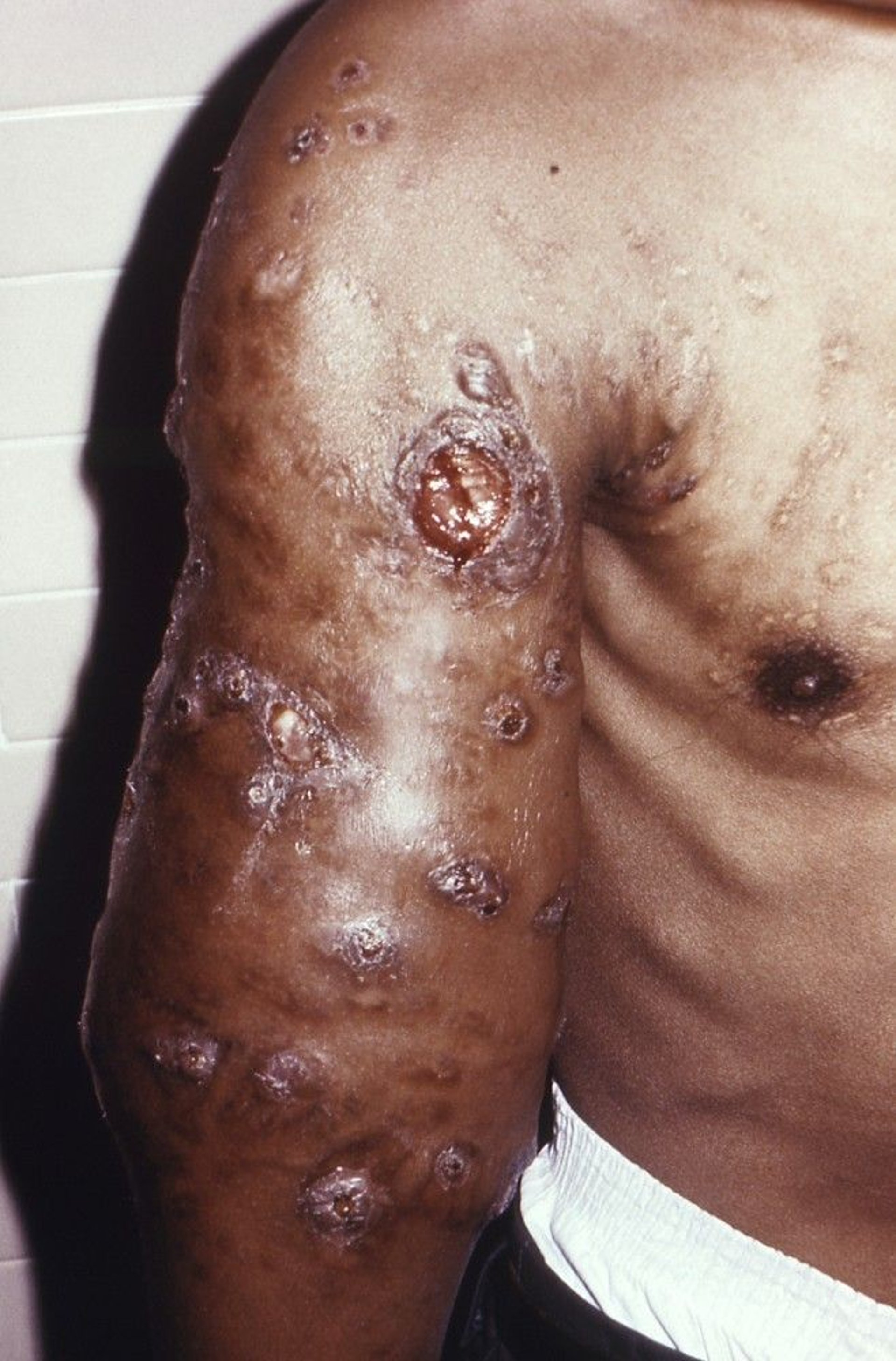 Actinomycotic Mycetoma